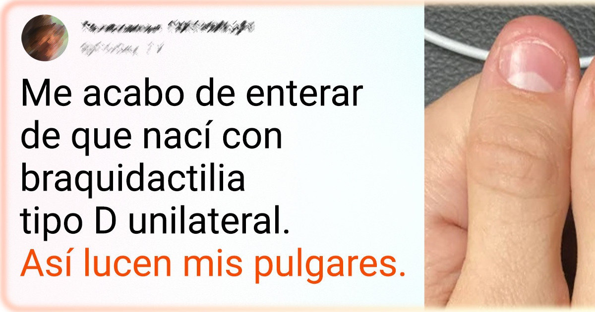 21 Personas a las que la naturaleza decidió otorgarles rasgos únicos y peculiares