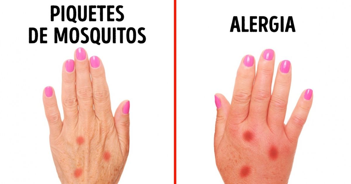 3 Señales que te ayudarán a detectar una alergia