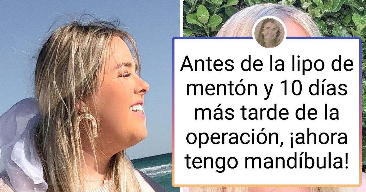 18 Personas que decidieron someterse a una cirugía plástica y olvidarse de sus complejos 18 Personas que decidieron someterse a una cirugía plástica y olvidarse de sus complejos