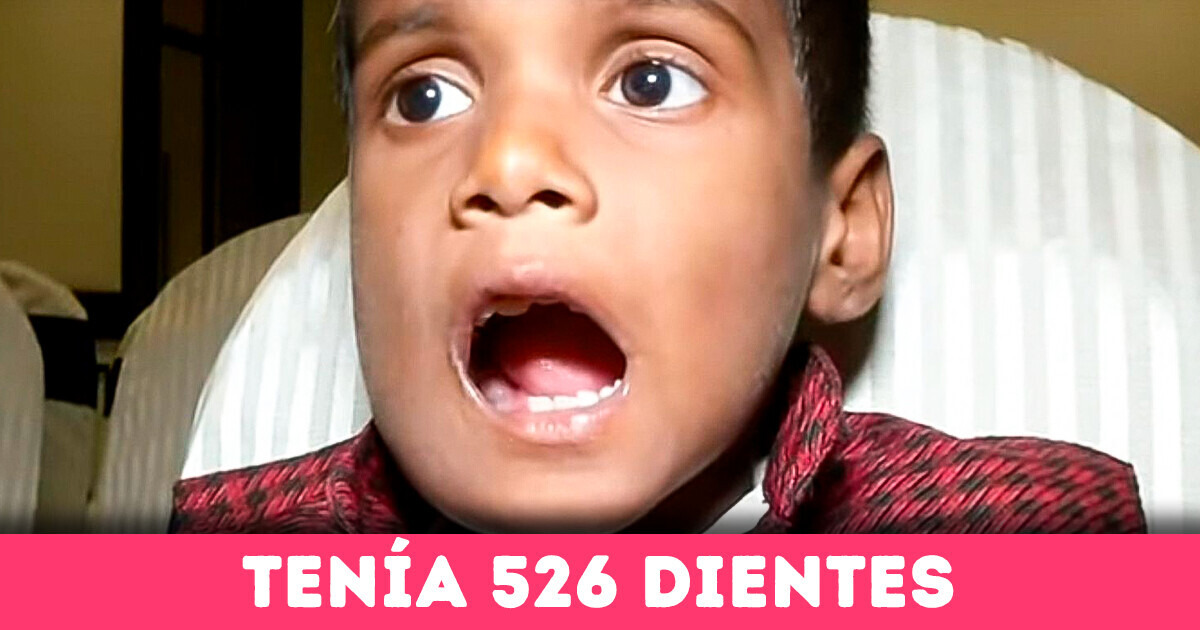 Especialistas quedaron asombrados por un niño que tenía más de 500 dientes