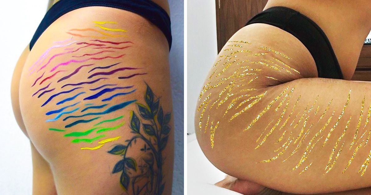 Cómo prevenir la aparición de estrías y qué hacer si ya existen Cómo prevenir la aparición de estrías y qué hacer si ya existen