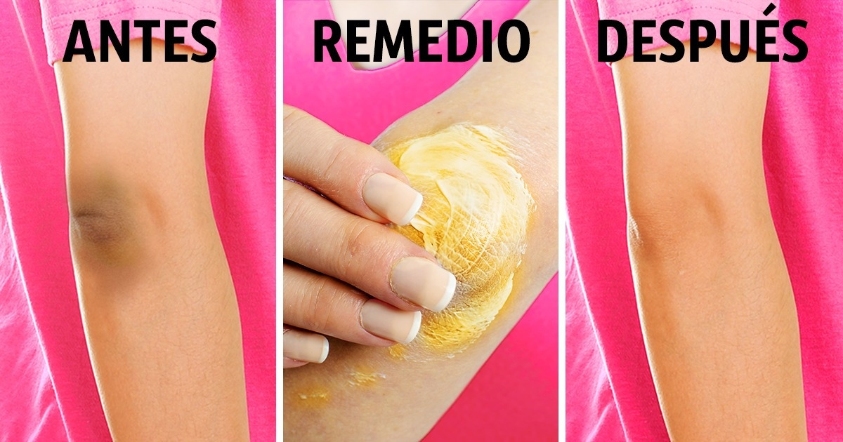 10 Remedios naturales para aclarar la piel de las rodillas y los codos /  Genial