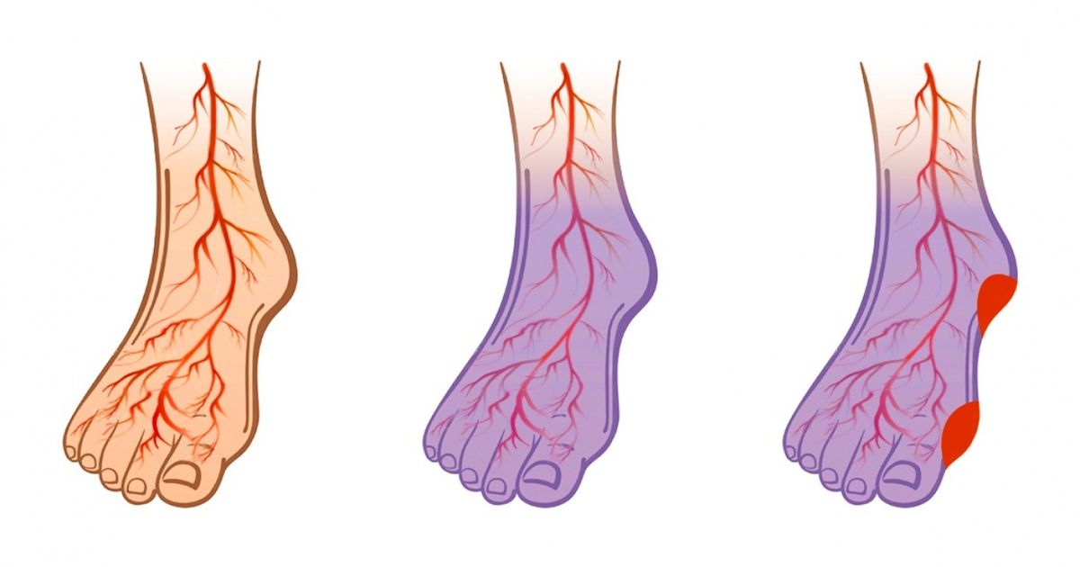 Si tienes presión arterial o venas varicosas, comienza a hacer estas 7 cosas Si tienes presión arterial o venas varicosas, comienza a hacer estas 7 cosas