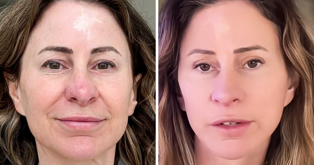 Una mujer vende su casa para pagarse un lifting facial: “Los resultados superan mis expectativas” Una mujer vende su casa para pagarse un lifting facial: “Los resultados superan mis expectativas”