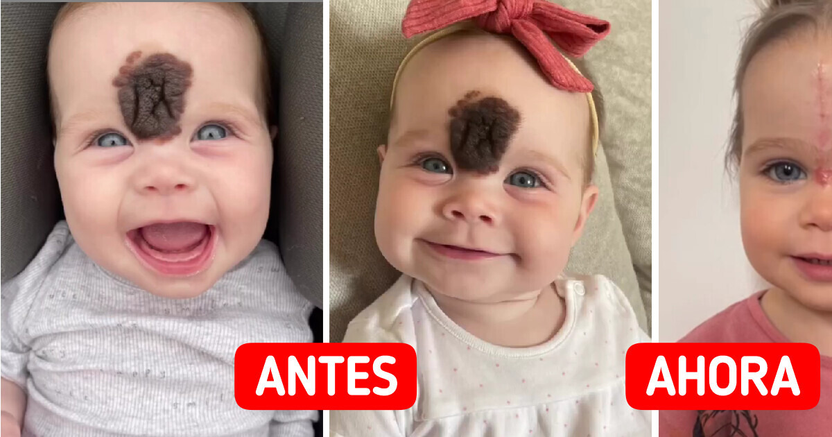 Los padres de una niña con una rara marca de nacimiento decidieron quitársela para evitar reacciones desagradables