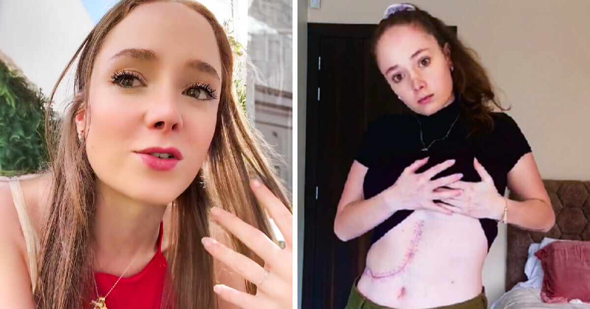 Le discriminan por tener una cicatriz resultado de su lucha contra una enfermedad, “me sentí pésimo”