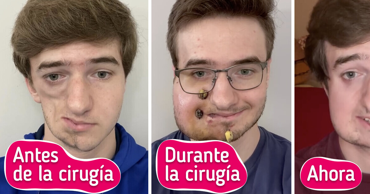 Así luce actualmente un hombre que vive con el síndrome de Parry-Romberg Así luce actualmente un hombre que vive con el síndrome de Parry-Romberg