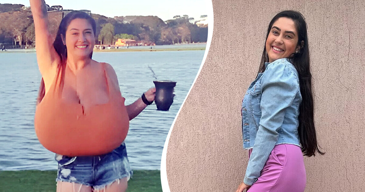 Joven con gigantomastia se somete a cirugía, pierde 10 kg y recupera su vida Joven con gigantomastia se somete a cirugía, pierde 10 kg y recupera su vida