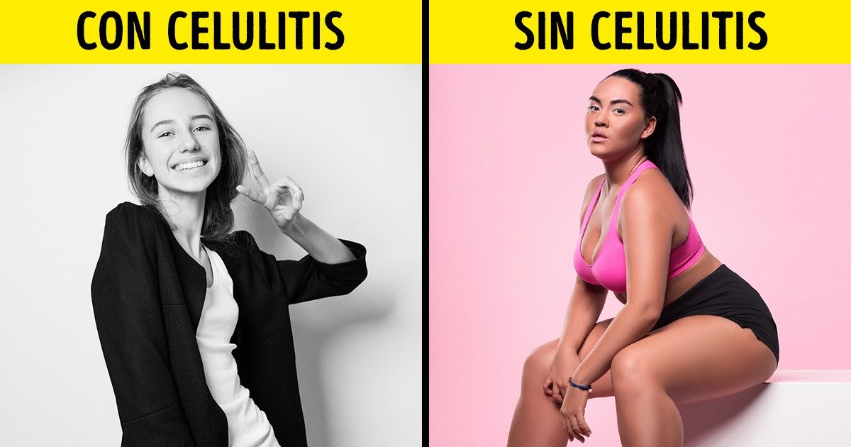 10 Mitos sobre la celulitis muchos siguen creyendo 10 Mitos sobre la celulitis muchos siguen creyendo