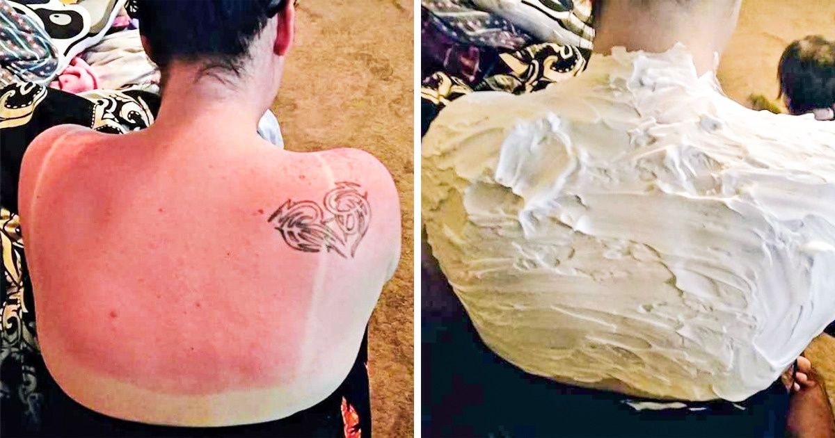 Prueba estas 8 formas naturales de tratar las quemaduras solares y mira cómo el dolor disminuye en un santiamén Prueba estas 8 formas naturales de tratar las quemaduras solares y mira cómo el dolor disminuye en un santiamén