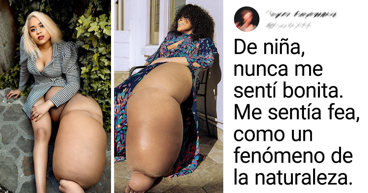Aspirante a modelo con una pierna de 45 kg se ama tal como es y demuestra que los prejuicios ya no gobiernan el mundo