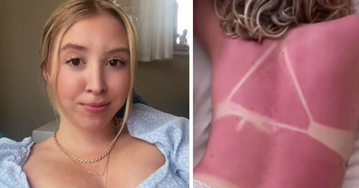 Vio que estaba nublado y no se puso bloqueador en la playa, acabó en el hospital Vio que estaba nublado y no se puso bloqueador en la playa, acabó en el hospital