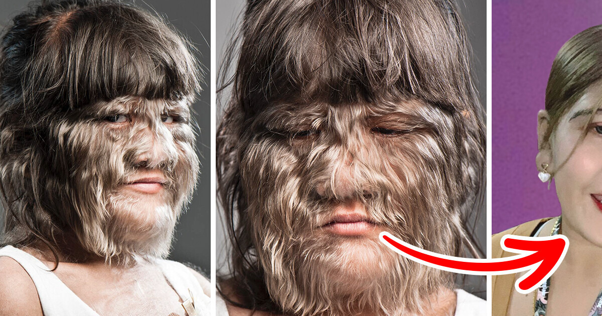 La chica más peluda del mundo se afeita completamente y ahora luce irreconocible La chica más peluda del mundo se afeita completamente y ahora luce irreconocible
