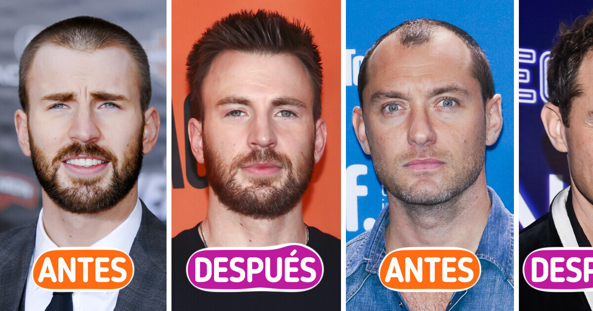 Cómo lucían 12 hombres famosos antes de someterse (supuestamente) a un trasplante de cabello Cómo lucían 12 hombres famosos antes de someterse (supuestamente) a un trasplante de cabello