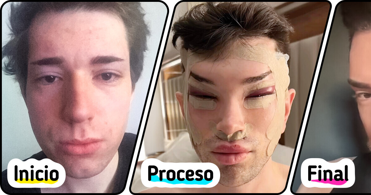 La radical transformación de un hombre tras cirugías en el rostro, para lograr su estética ideal La radical transformación de un hombre tras cirugías en el rostro, para lograr su estética ideal