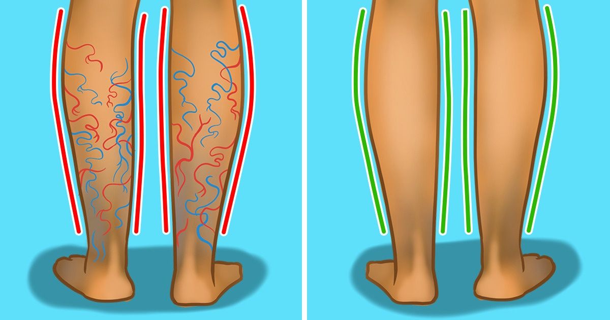 10 Formas con las que podrías reducir o evitar la aparición de las várices 10 Formas con las que podrías reducir o evitar la aparición de las várices