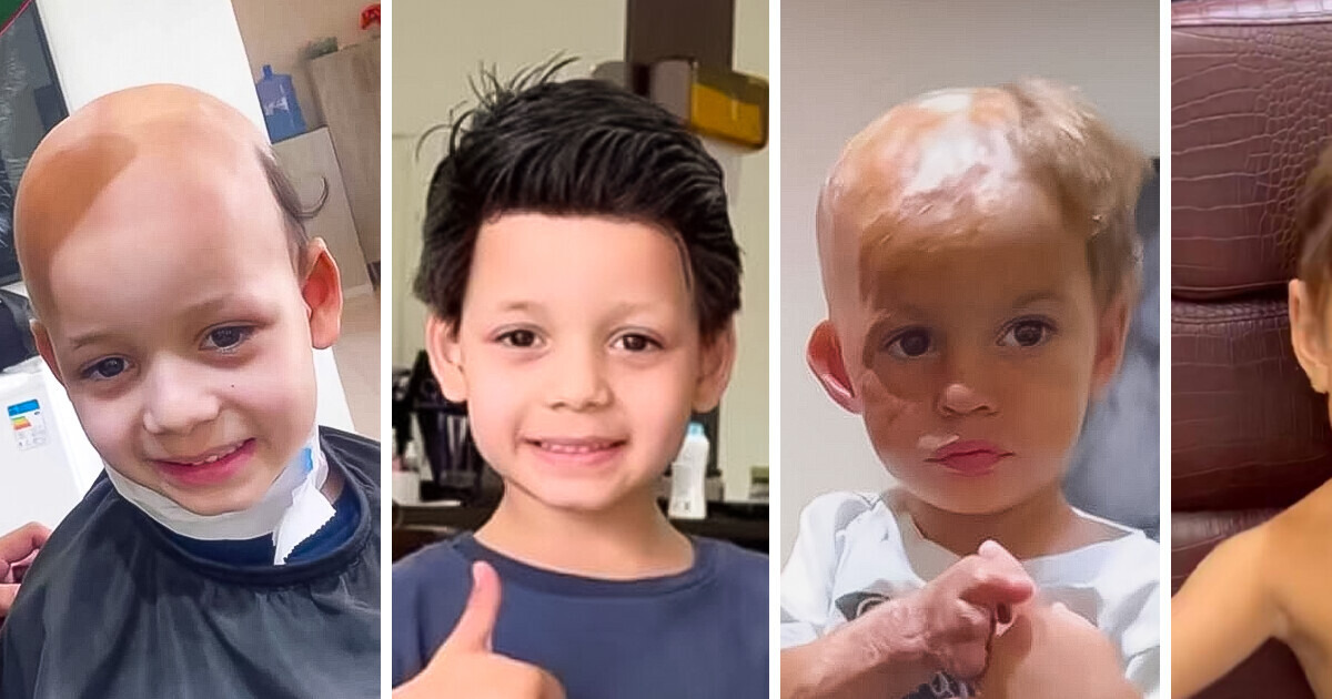 Peluquero en Brasil usa su don para devolverle la autoestima a niños que tuvieron accidentes