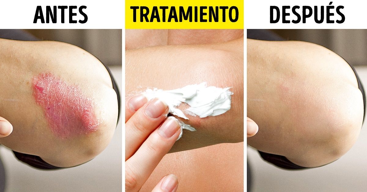 10 Maneras comprobadas de tratar las afecciones comunes de la piel de una manera natural 10 Maneras comprobadas de tratar las afecciones comunes de la piel de una manera natural