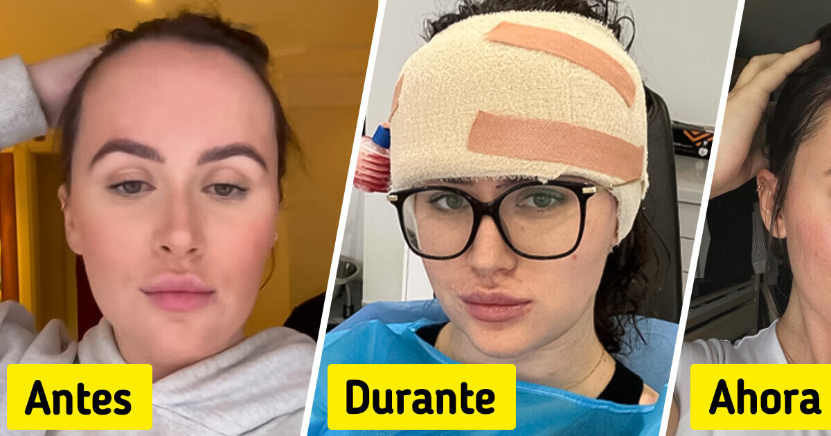 Una mujer, criticada por el tamaño de su frente, optó por una cirugía plástica para reducirla