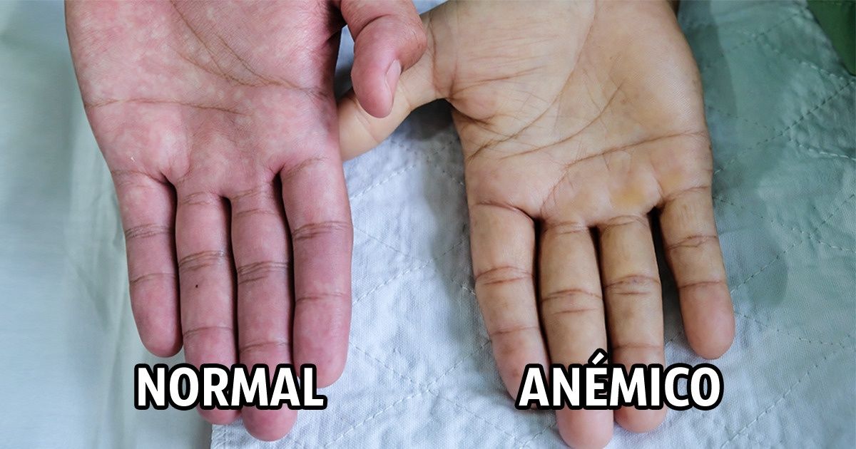 Signos de anemia y tratamientos para estos que quizás no conozcas Genial