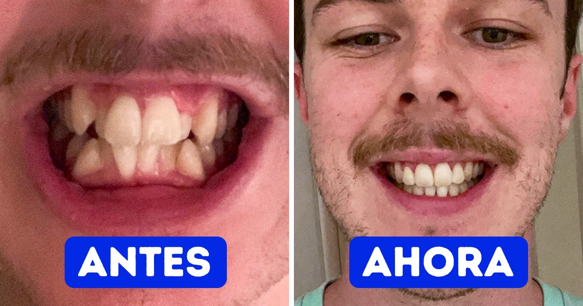 19 Transformaciones de sonrisas por las que los usuarios nunca olvidarán a su dentista