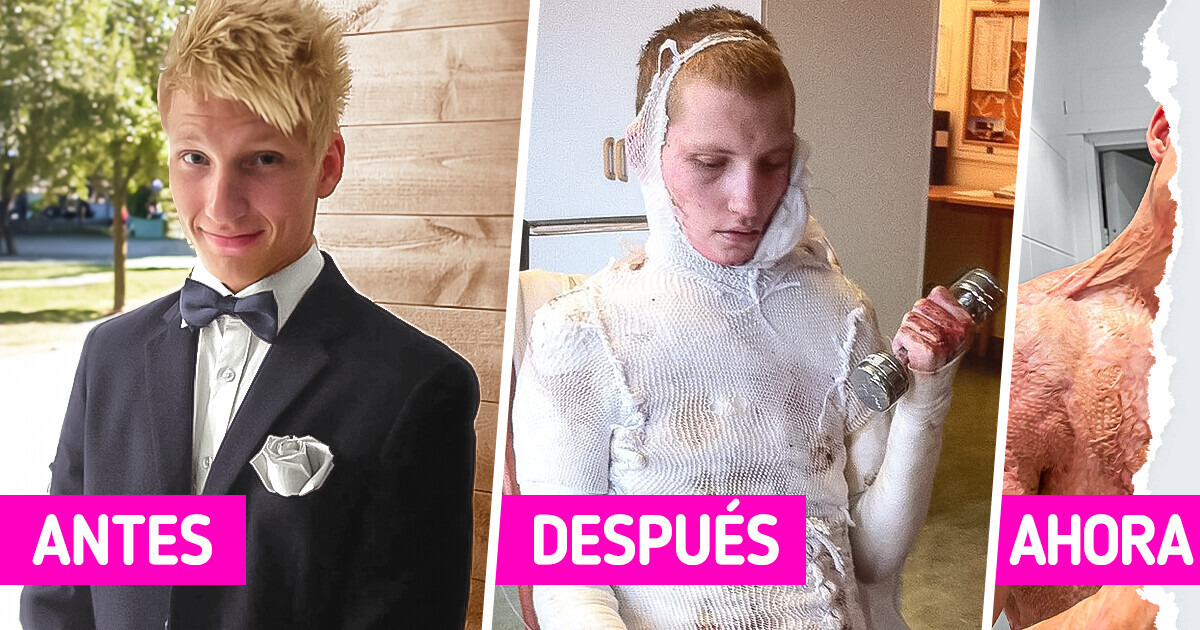 Un cantante abraza su nuevo look después de que la mayor parte de su cuerpo fuera electrocutado