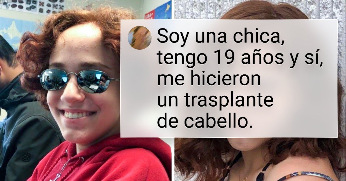 10+ Personas que tuvieron que lidiar con la pérdida de pelo, hasta que tomaron cartas en el asunto