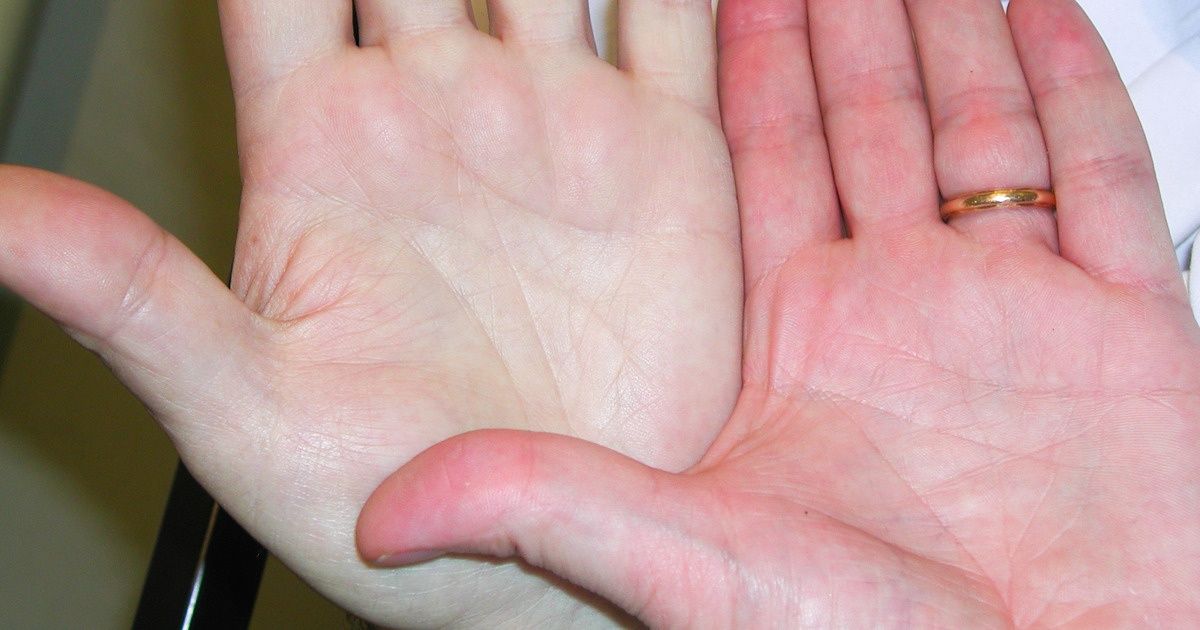 7 Señales del organismo que indican que te urge subir el nivel de hemoglobina 7 Señales del organismo que indican que te urge subir el nivel de hemoglobina