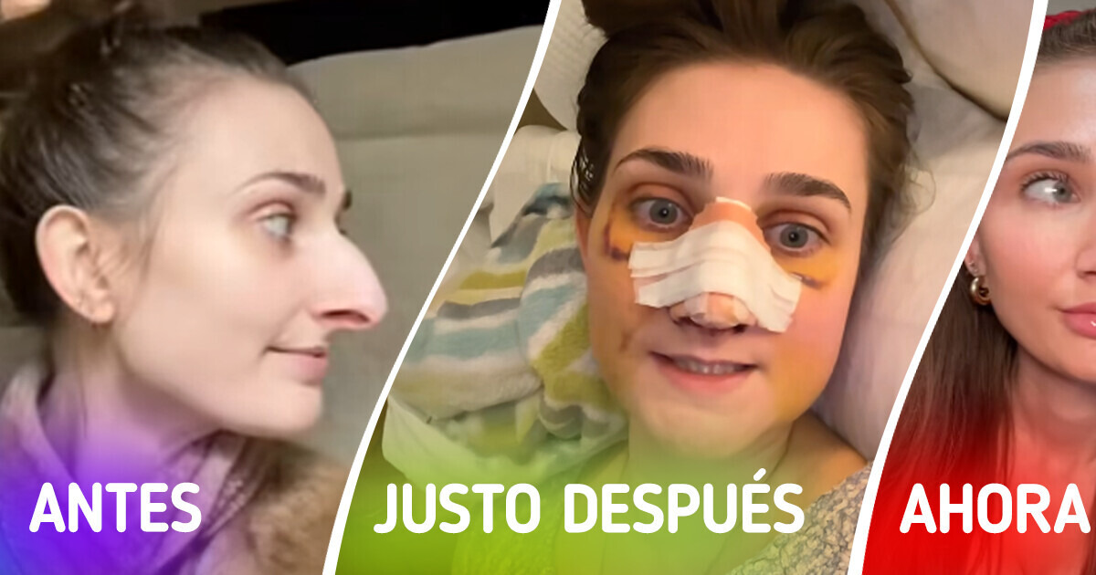 Una mujer comparte los resultados de su cirugía plástica y deja a todos asombrados con su transformación Una mujer comparte los resultados de su cirugía plástica y deja a todos asombrados con su transformación