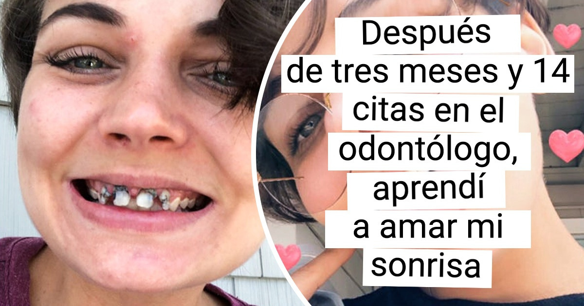 15+ Personas que decidieron ir al odontólogo, y lograron tener una sonrisa de oreja a oreja