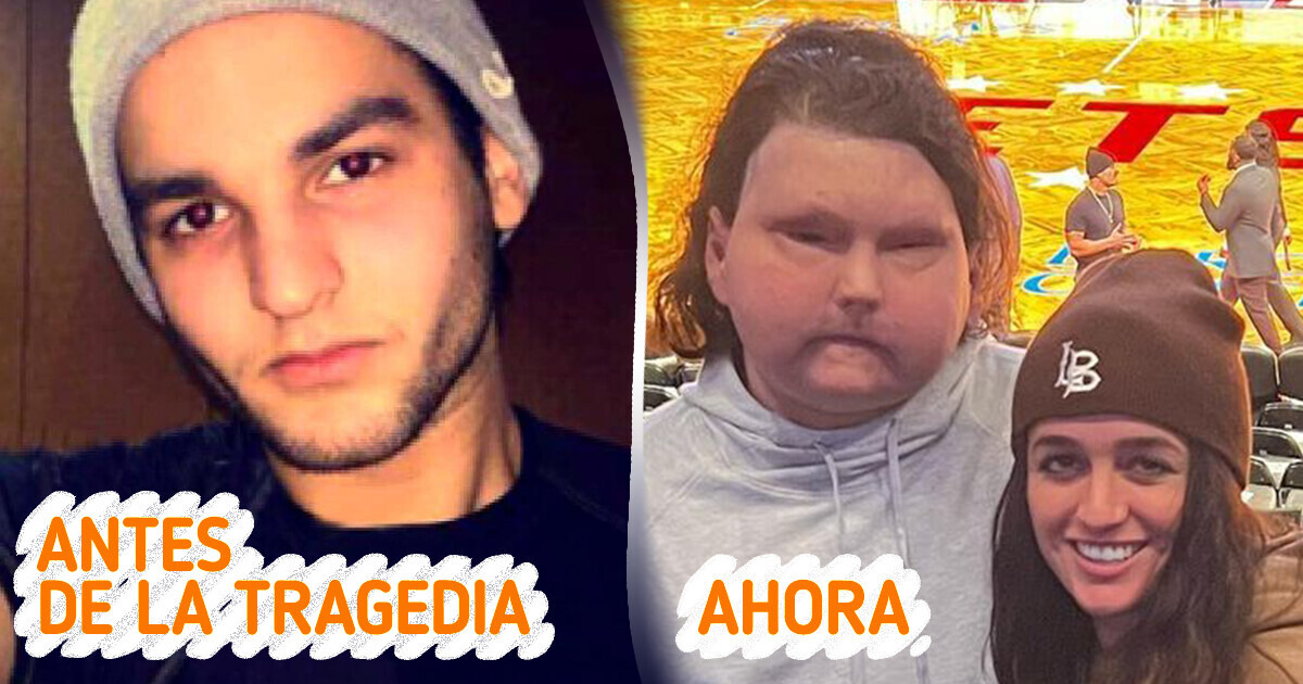 El hombre del primer trasplante de rostro encuentra el amor verdadero y comparte una dulce actualización El hombre del primer trasplante de rostro encuentra el amor verdadero y comparte una dulce actualización