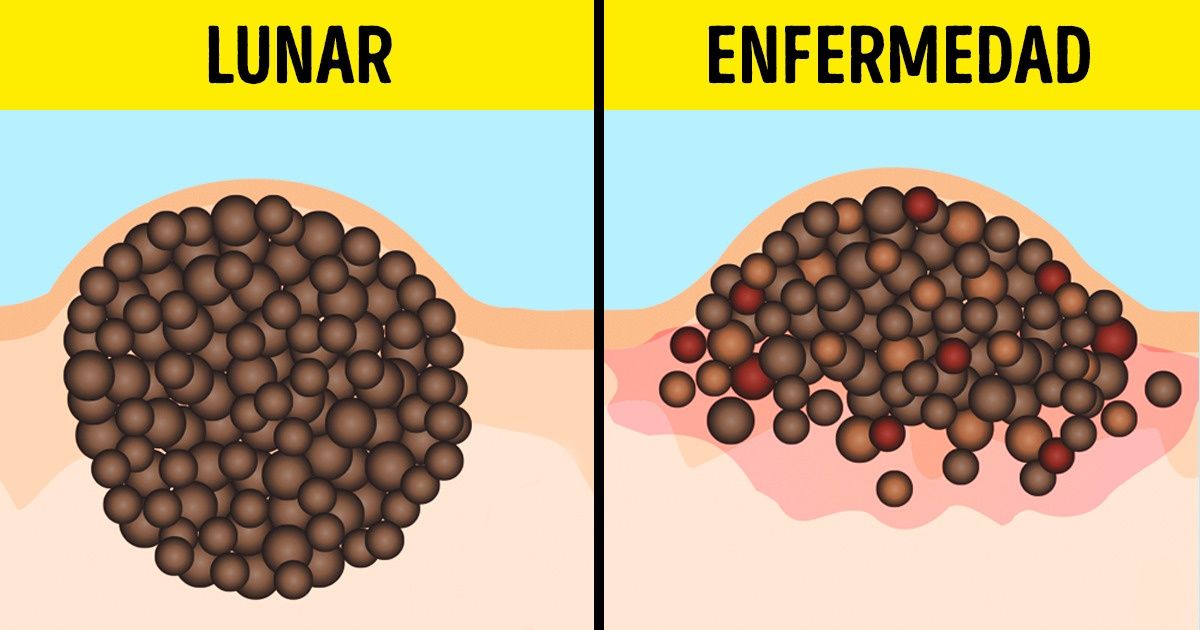 9 Mitos peligrosos sobre el bronceado y los lunares que hasta algunos médicos creen 9 Mitos peligrosos sobre el bronceado y los lunares que hasta algunos médicos creen