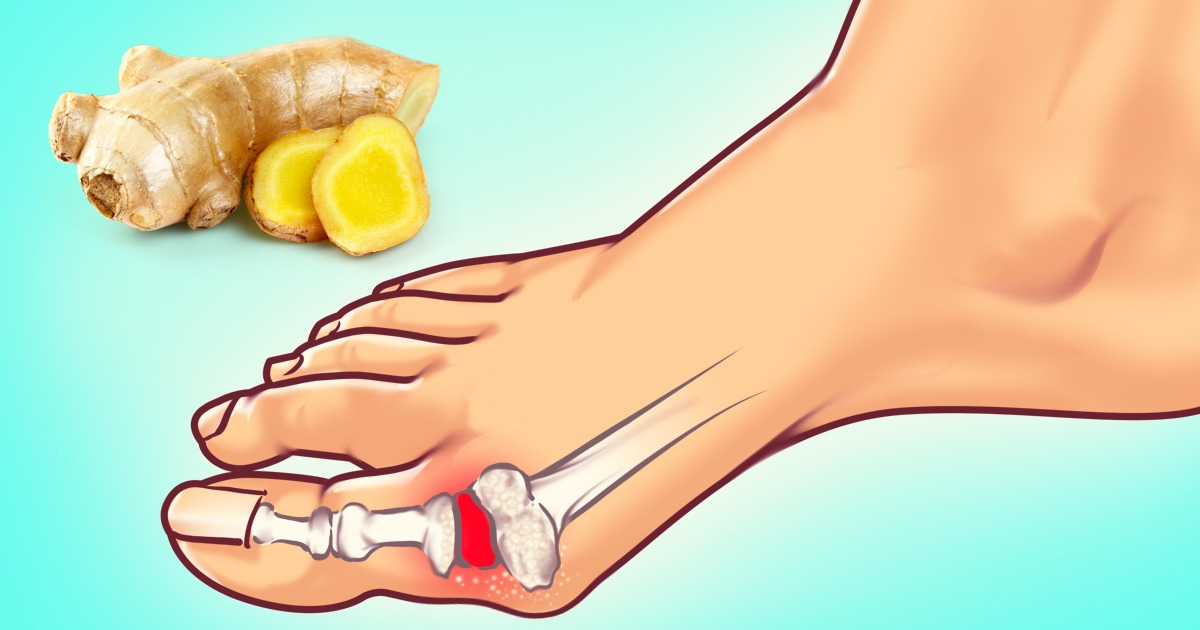 Los médicos revelaron los mejores consejos para controlar el dolor de un ataque de gota Los médicos revelaron los mejores consejos para controlar el dolor de un ataque de gota