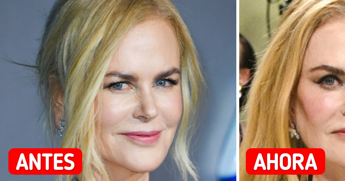 “Arruinó su cara”, la apariencia de Nicole Kidman en la Met Gala desata la preocupación “Arruinó su cara”, la apariencia de Nicole Kidman en la Met Gala desata la preocupación