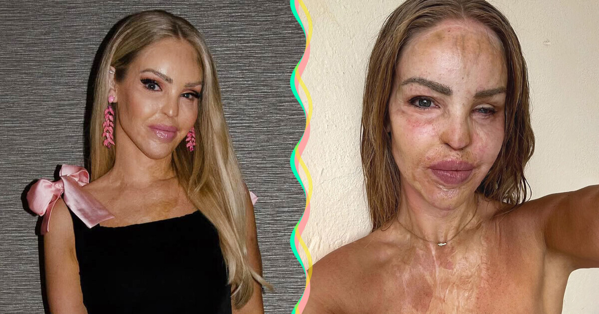 Katie Piper refleja su increíble transformación 16 años después del ataque con ácido Katie Piper refleja su increíble transformación 16 años después del ataque con ácido