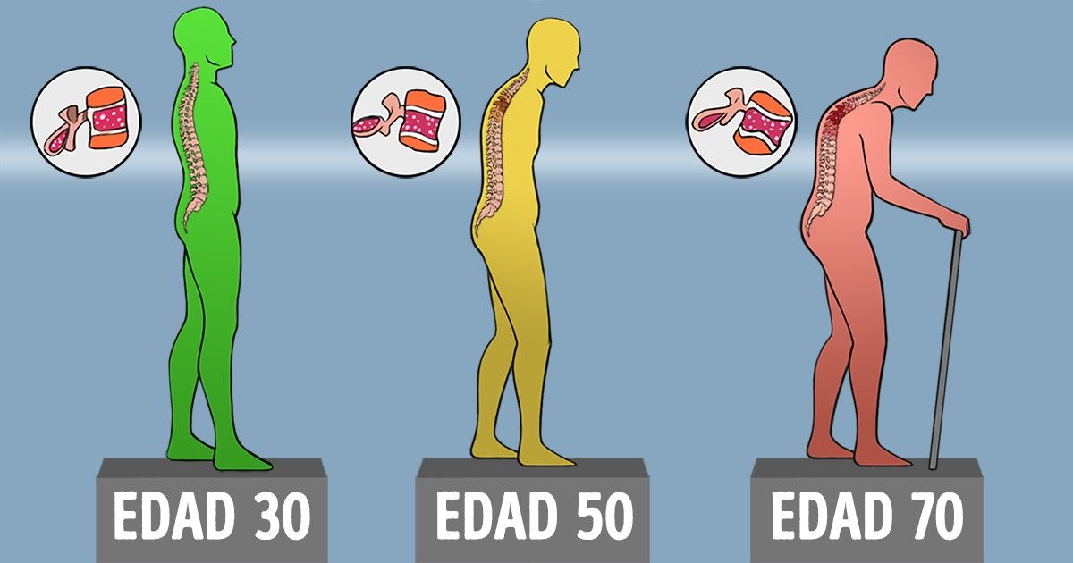 Tus huesos se vuelven más débiles año tras año, pero hay formas de mantenerlos sanos