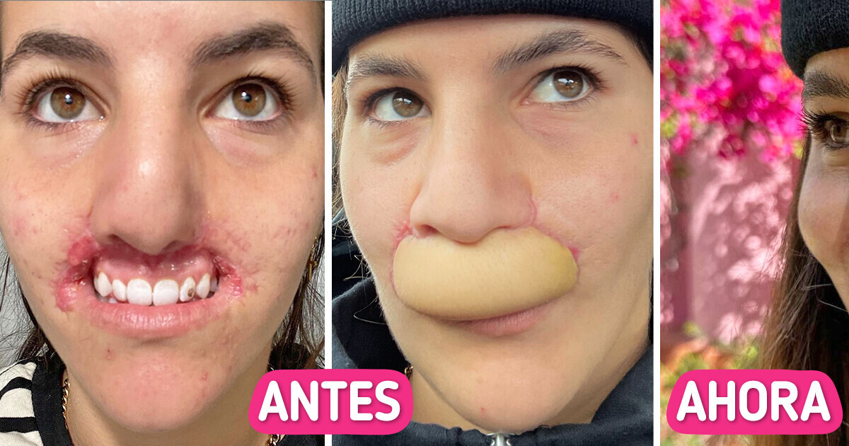 Modelo pierde todo el labio en un ataque de pitbull y reflexiona sobre su proceso de recuperación