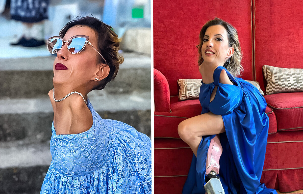 Mujer con extraña condición rompe estereotipos y se convierte en inspiración para muchos