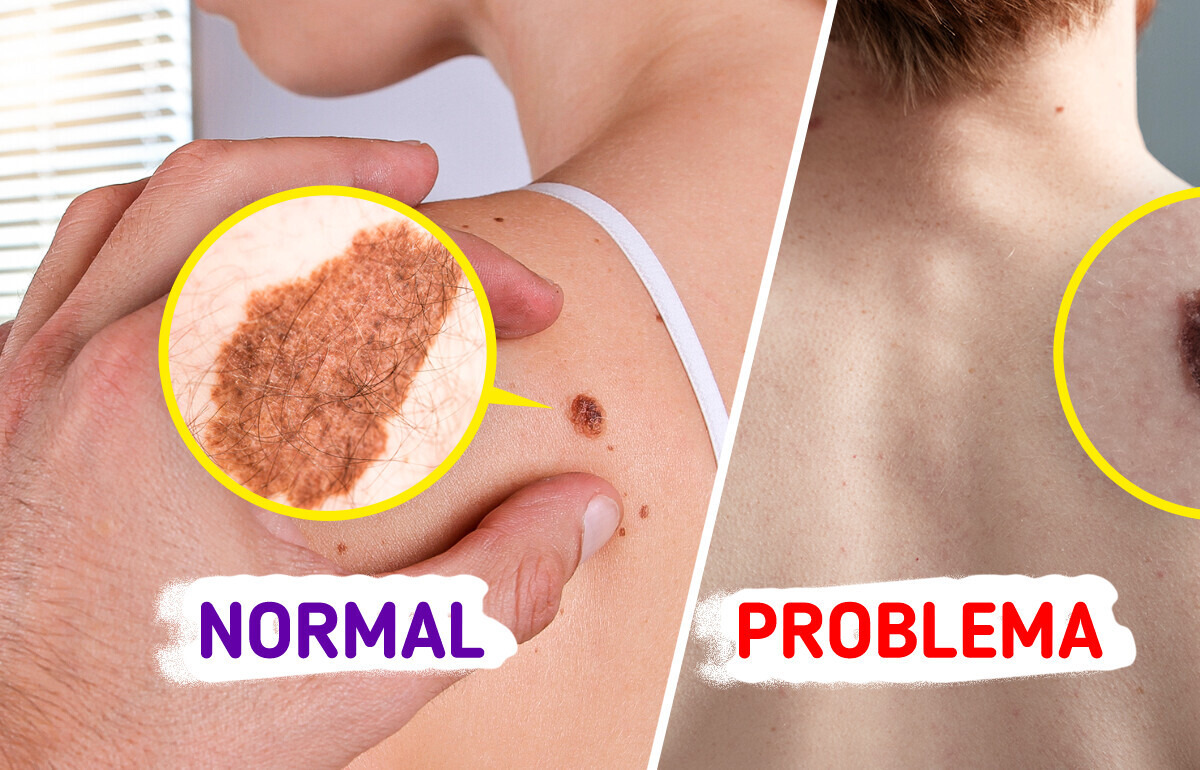 Cuidado con tus lunares: 5 signos que podrían alertarte de un cáncer de piel