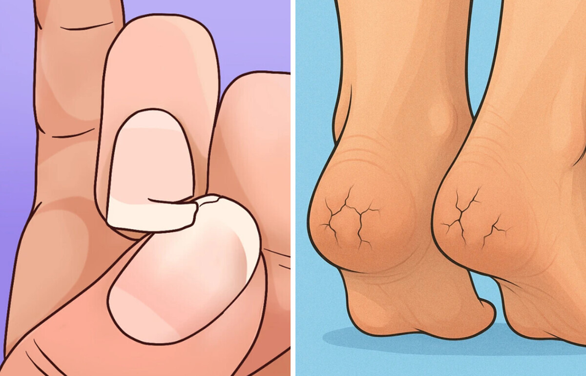 12 Síntomas inesperados de intolerancia a los lácteos