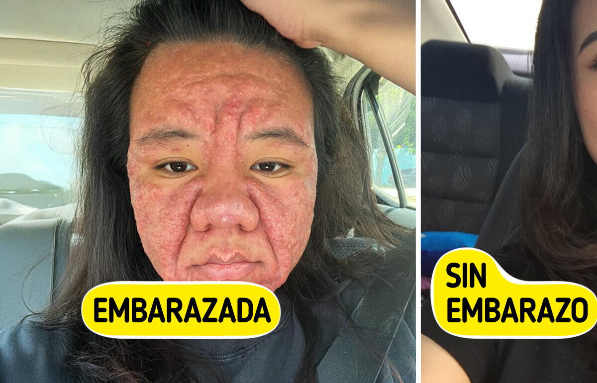Mujer de 28 años revela la cruda realidad de cómo el embarazo transformó su rostro