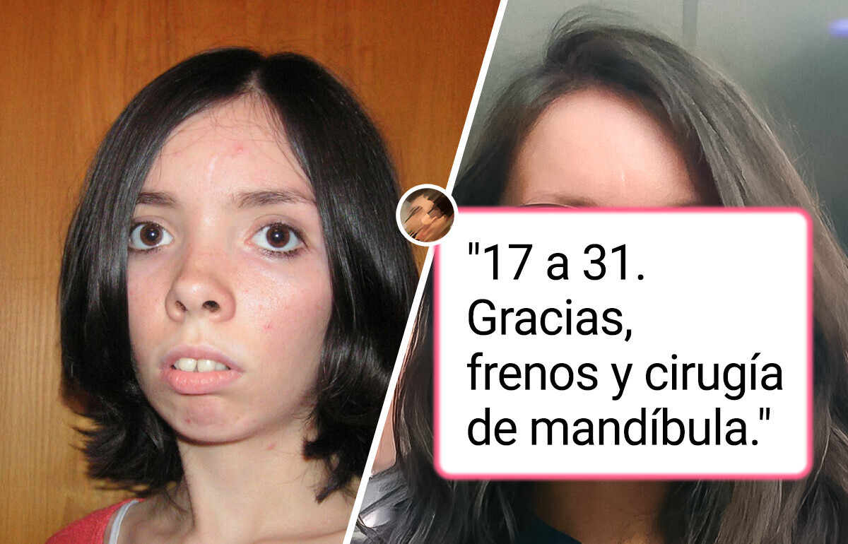 18 Personas que transformaron su apariencia con cirugía plástica y lograron resultados asombrosos