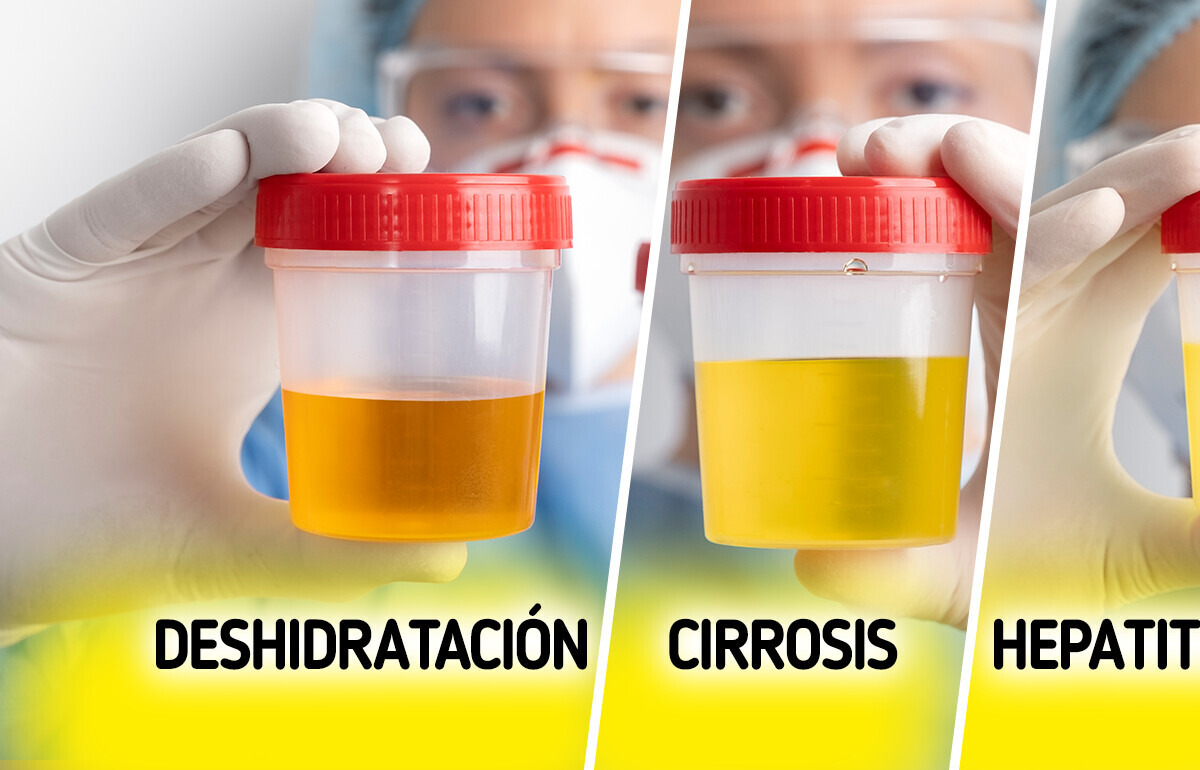 5+ Colores de orina inusuales que nunca deberías ignorar (y qué significan)