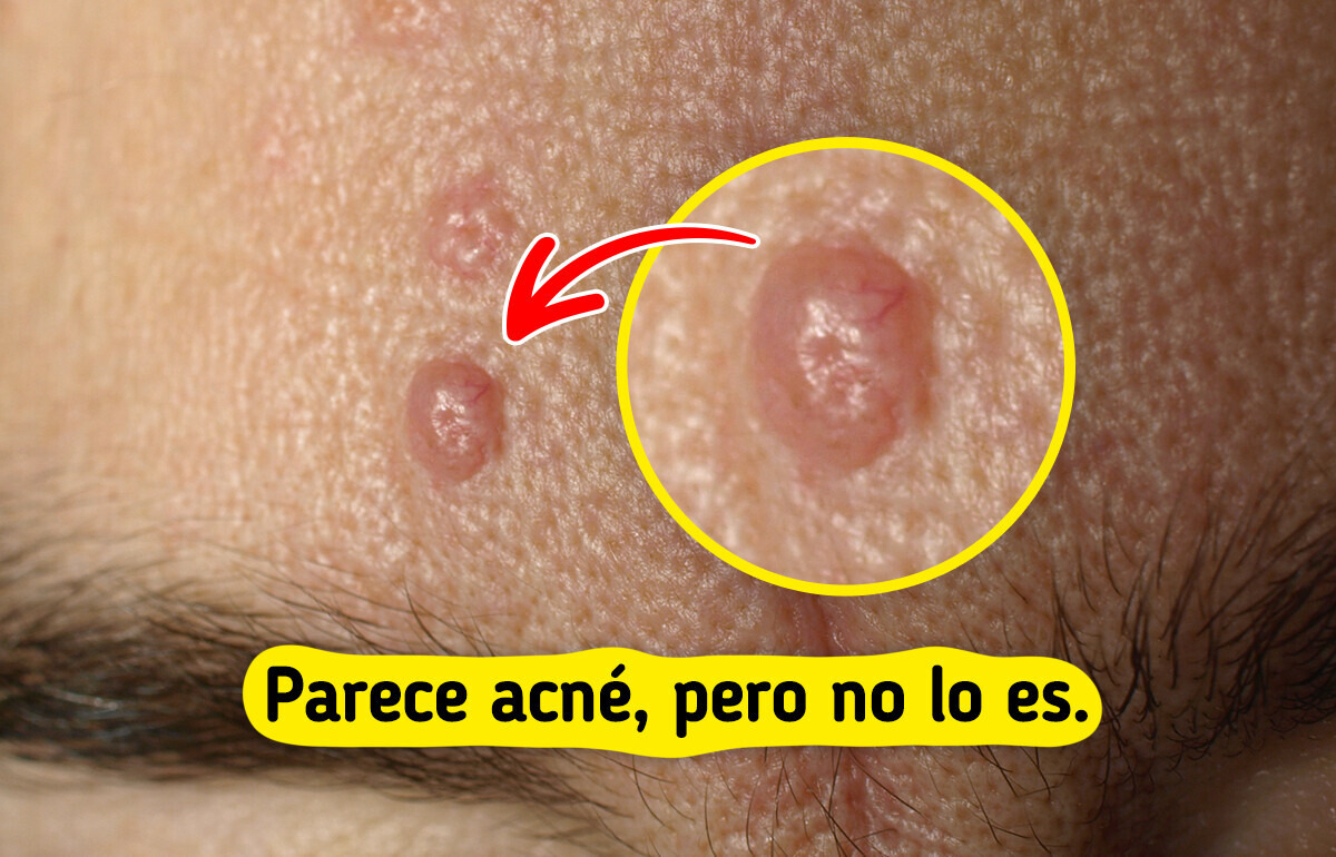 7 Bultitos en la piel que podrías confundir con acné (y no lo son)