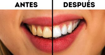 Los dentistas revelan 10 formas sencillas de prevenir la caries dental