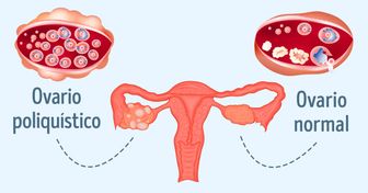 10 Razones para tener cuidado con el síndrome de ovario poliquístico