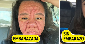 Mujer de 28 años revela la cruda realidad de cómo el embarazo transformó su rostro