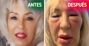 “Parezco una gárgola”, mujer advierte sobre los riesgos de los rellenos faciales