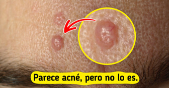 7 Bultitos en la piel que podrías confundir con acné (y no lo son)