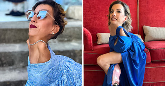 Mujer con extraña condición rompe estereotipos y se convierte en inspiración para muchos